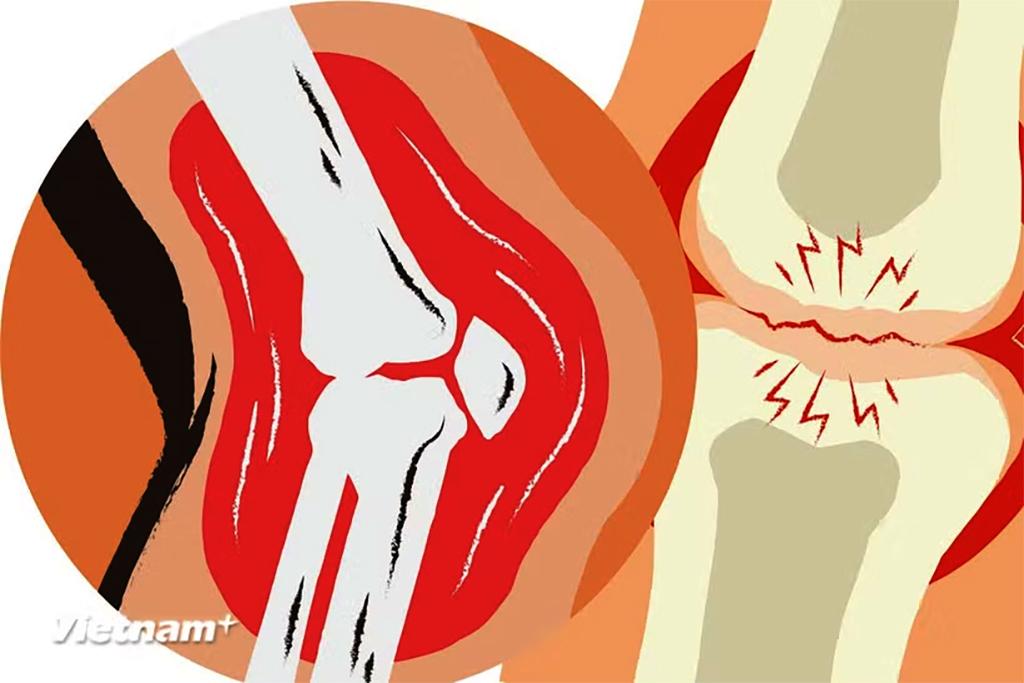 Ung thư xương ác tính là một dạng ung thư xương hiếm gặp. (Nguồn: Vietnam+)