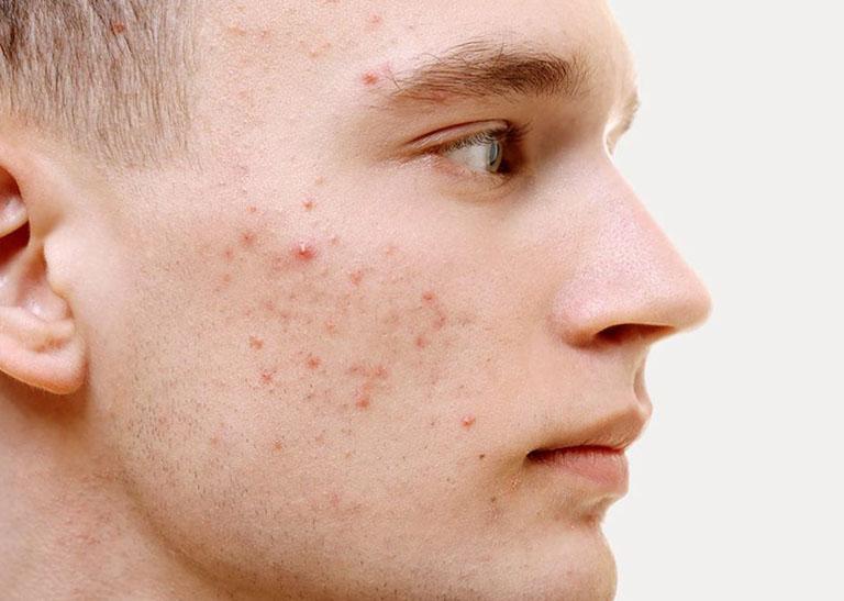 Trị mụn trứng cá tuổi dậy thì