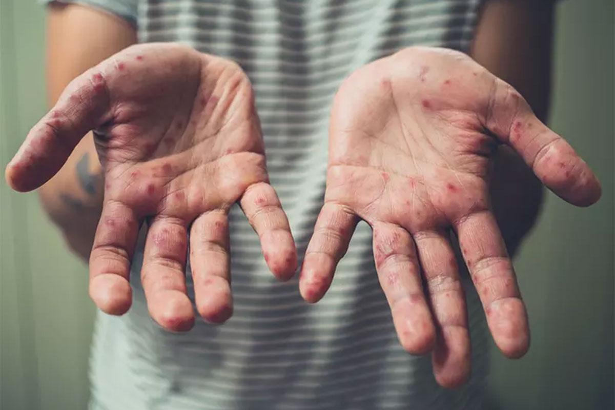 Người lớn mắc bệnh tay chân miệng có nguy hiểm không?