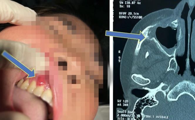 Bộ Y tế yêu cầu tìm nguyên nhân bệnh hoại tử xương hàm