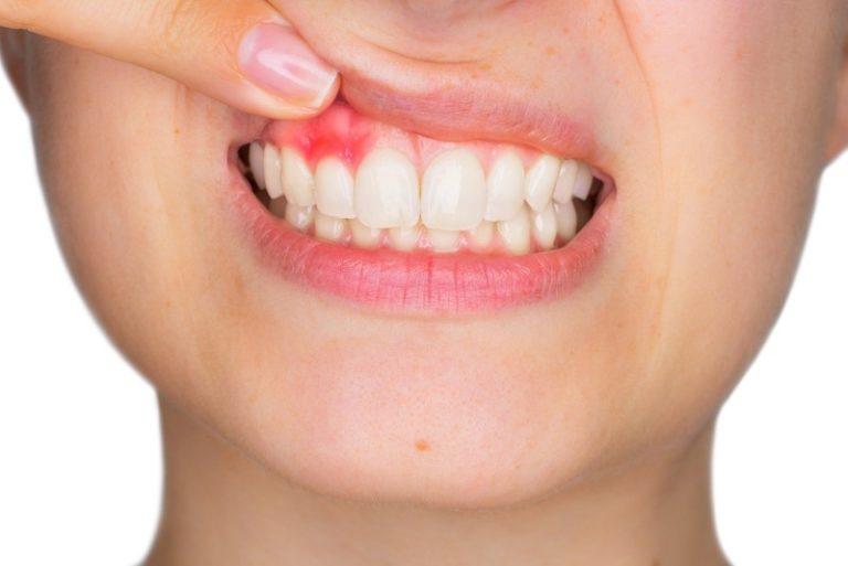 WHO: 45% dân số thế giới mắc các bệnh về răng miệng