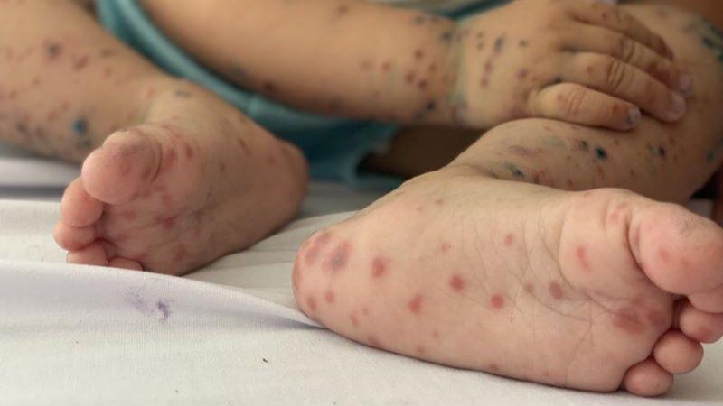 Bộ Y tế thông tin về thuốc điều trị bệnh tay chân miệng