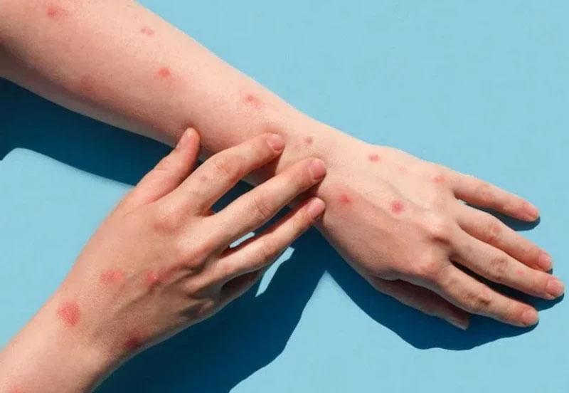 Việt Nam đã ghi nhận 56 ca đậu mùa khỉ