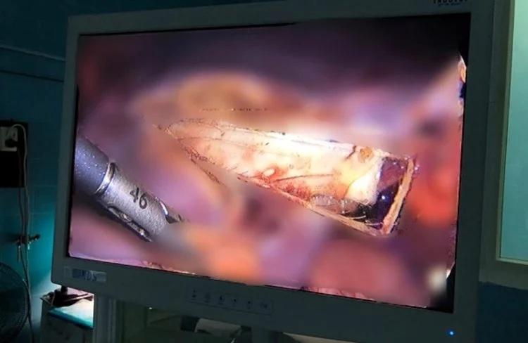 Hi hữu người đàn ông sống với mảnh thủy tinh găm vào gan cả chục năm trời