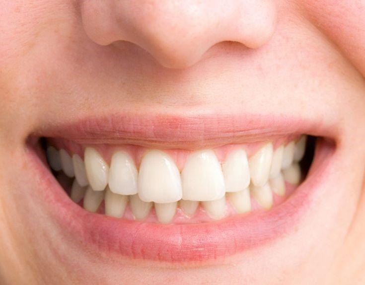 Bị hô nhẹ được khuyến cáo là nên niềng răng để cải thiện.