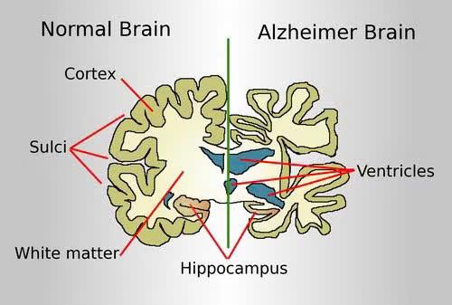 Bộ não của người mắc Alzheimer và của người bình thường. (Nguồn: Wikipedia)