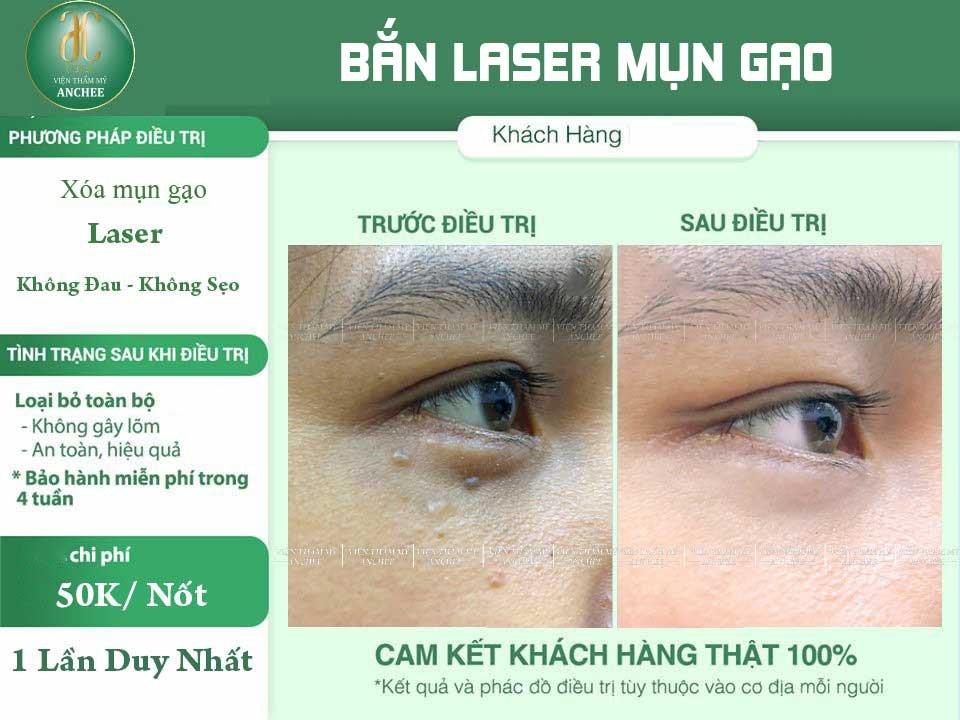 Spa xóa mụn gạo có tốt không? Nên xóa mụn gạo ở đâu?