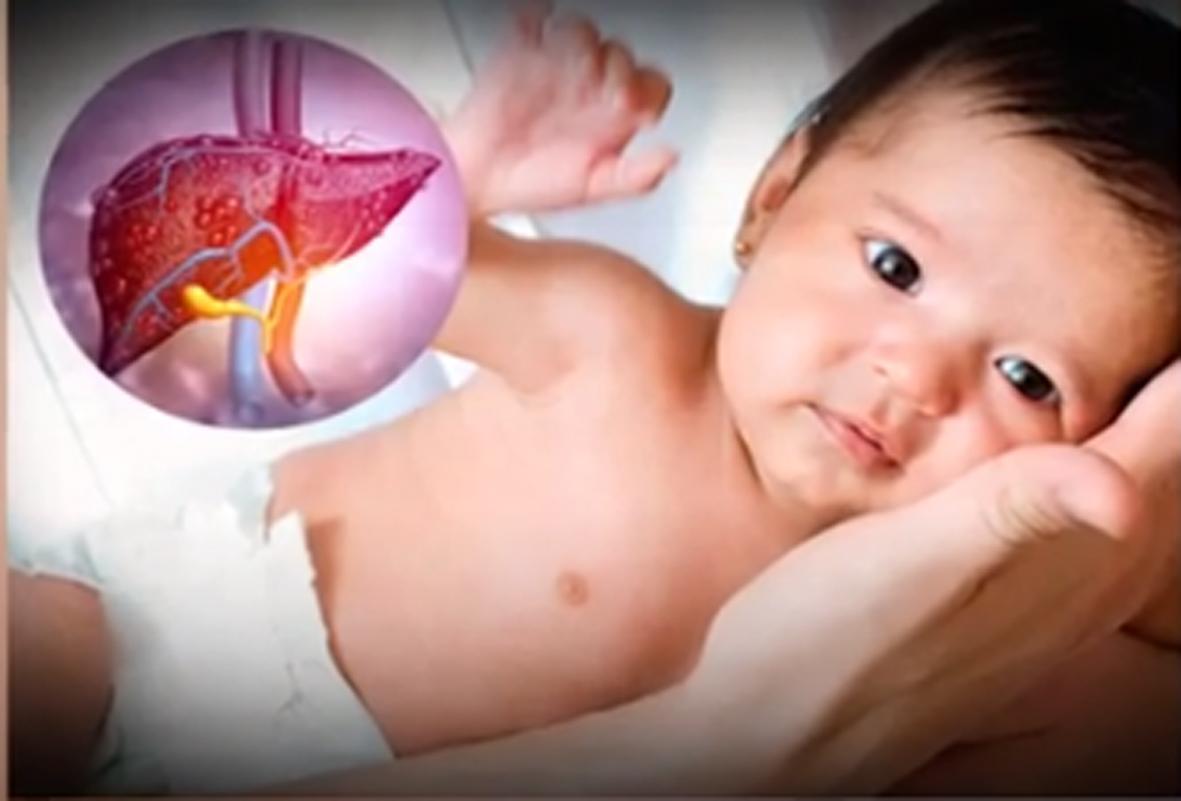 Viêm gan cấp tính xảy ra ở trẻ em có triệu chứng như thế nào?