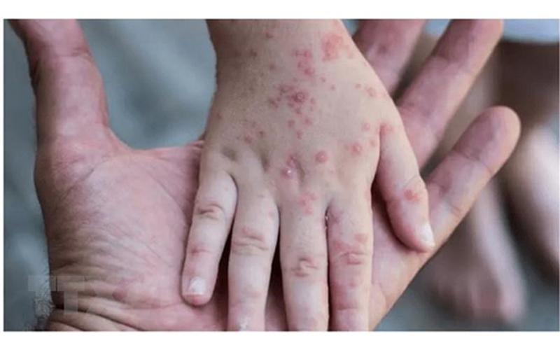 Các triệu chứng đậu mùa khỉ xuất hiện từ 1-2 tuần sau khi nhiễm bệnh