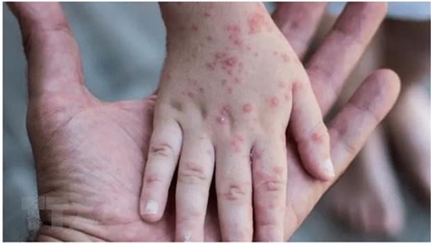 Tổ chức Y tế Thế giới: Virus đậu mùa khỉ có thể đã âm thầm lây lan