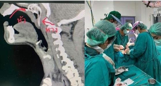 Người đàn ông phải nhập viện vì bị cá rô lao vào cổ họng