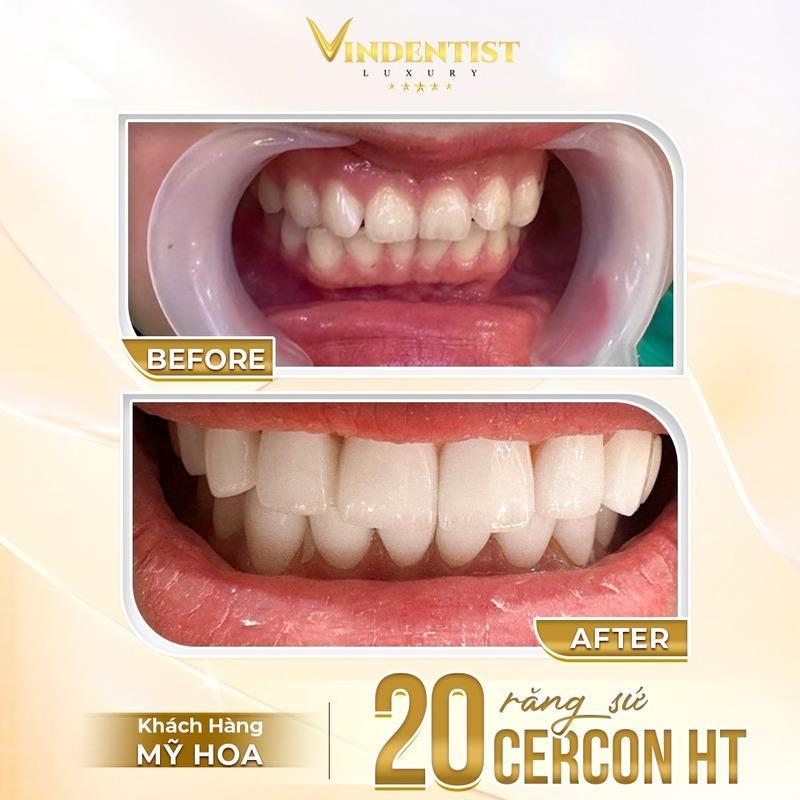 Có nên bọc răng sứ không? Ở Đà Nẵng bọc răng sứ ở đâu uy tín?