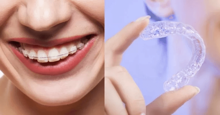 Niềng răng trong suốt - Trải nghiệm thẩm mỹ cao, không lo về chi phí