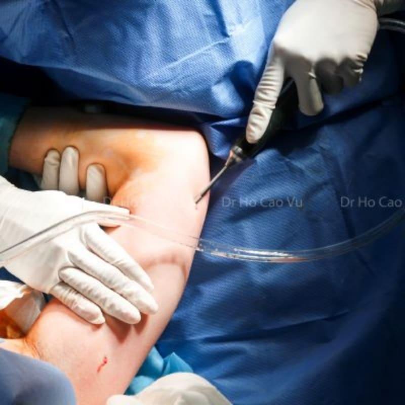 Hút mỡ bắp tay bị lồi lõm và những gì bạn cần biết