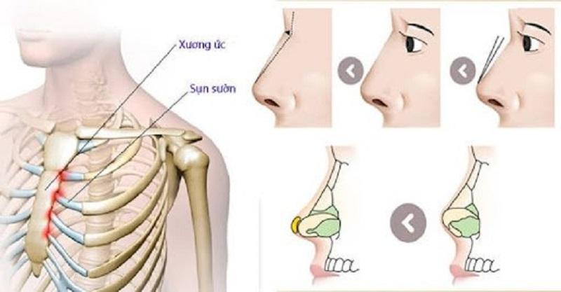 Giải đáp câu hỏi: Nâng mũi sụn sườn có bị teo lại không?