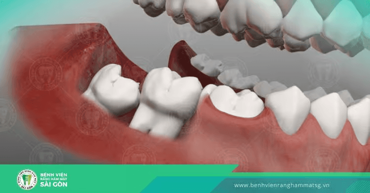 Cần làm gì khi bị đau răng khôn? Đến khám ngay tại Bệnh viện RHM Sài Gòn