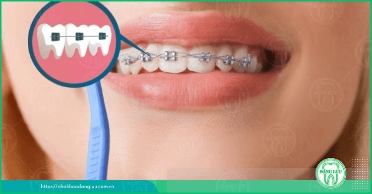 Niềng răng hay bọc răng sứ, phương pháp nào hiệu quả hơn?