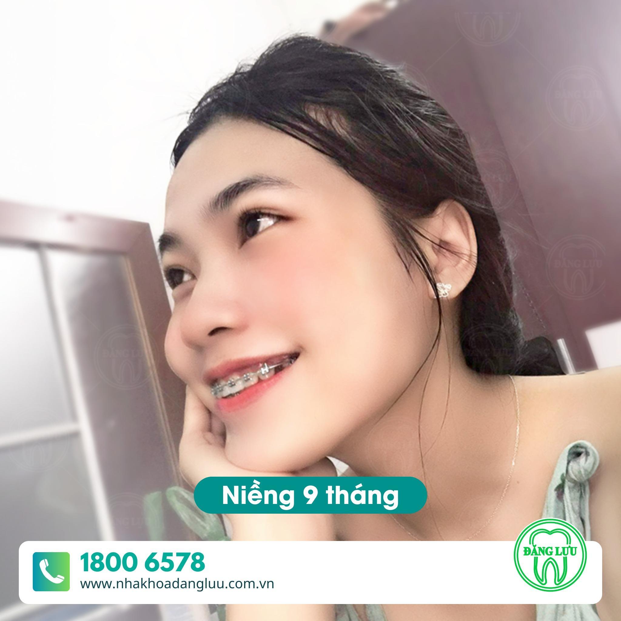 Ưu điểm của phương pháp niềng răng tại Nha Khoa Đăng Lưu