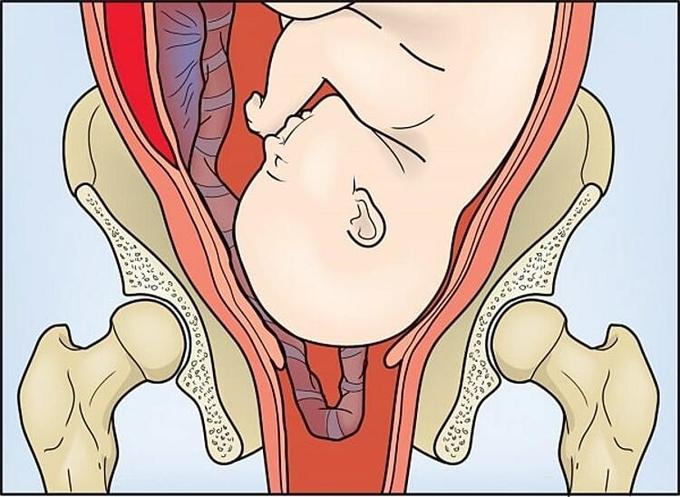 Sa dây rốn - biến chứng nguy hiểm cuối thai kỳ