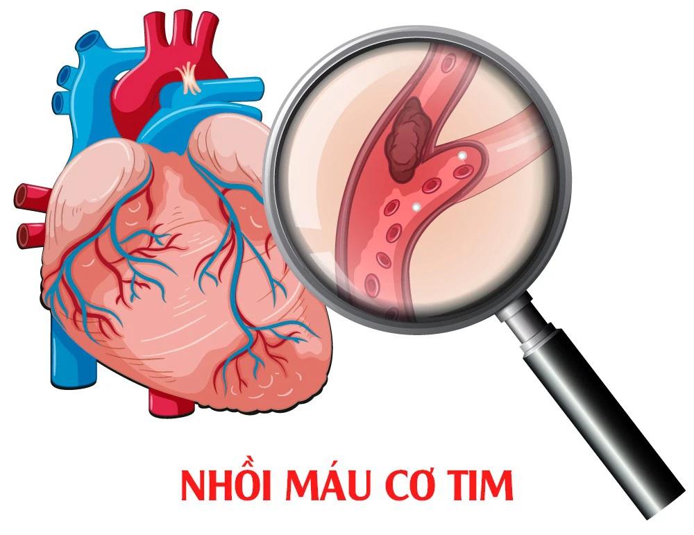 Sức khỏe và Đời sống: Dấu hiệu điển hình của cơn nhồi máu cơ tim