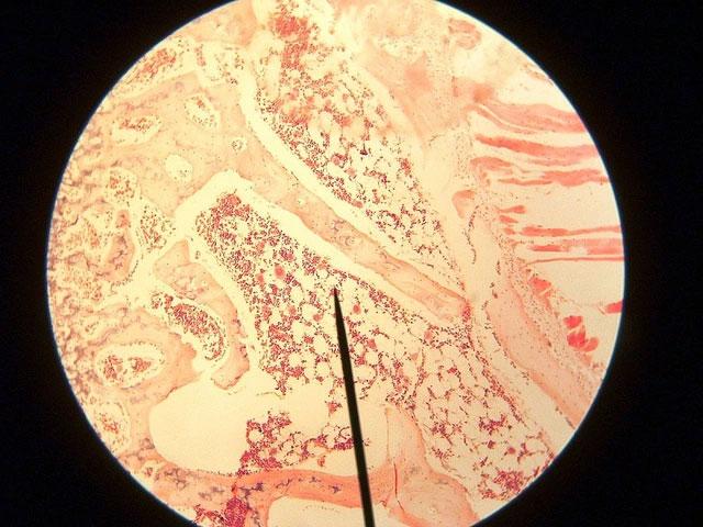 Cần làm gì để phát hiện suy tủy xương?