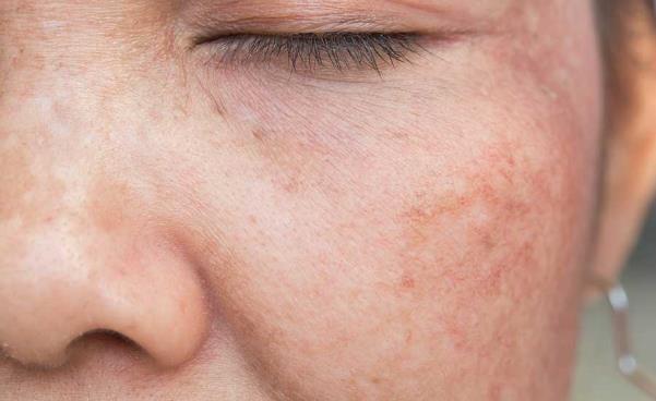 Bác sĩ chỉ ra nguyên nhân gây sạm nám và cách khắc phục