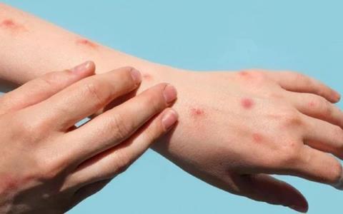 WHO: 167 ca tử vong do bệnh đậu mùa khỉ trong 2 năm qua