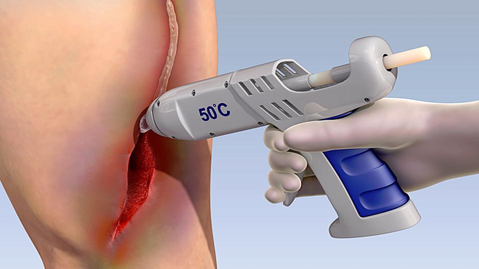 Súng bắn keo sinh học chữa lành vết thương