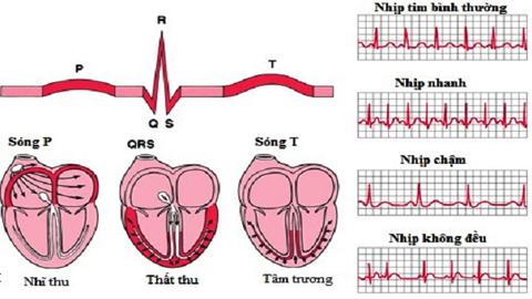 Ðau tim thầm lặng - Cách nhận biết và ứng phó