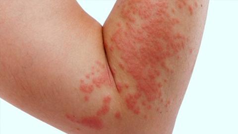 Một số bệnh tấn công da mùa hanh khô