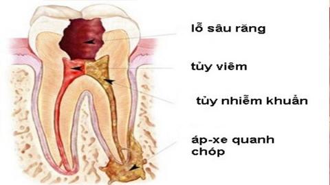 Phòng viêm nhiễm hàm mặt
