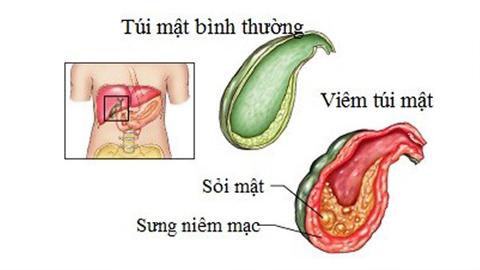Viêm túi mật và những nguy biến