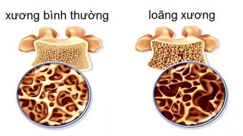 Khi bị loãng xương sớm