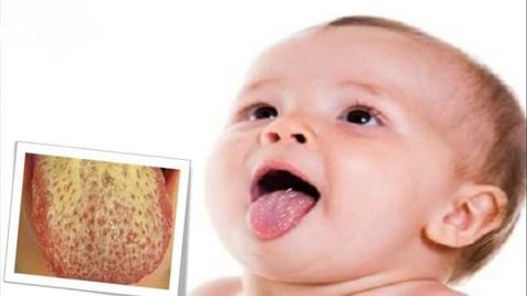 Dấu hiệu nhận biết nhiễm nấm họng - miệng